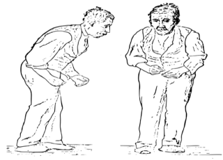 مرض باركنسون